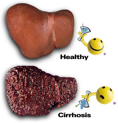 A Healthy Liver vs. a liver with cirrhosis